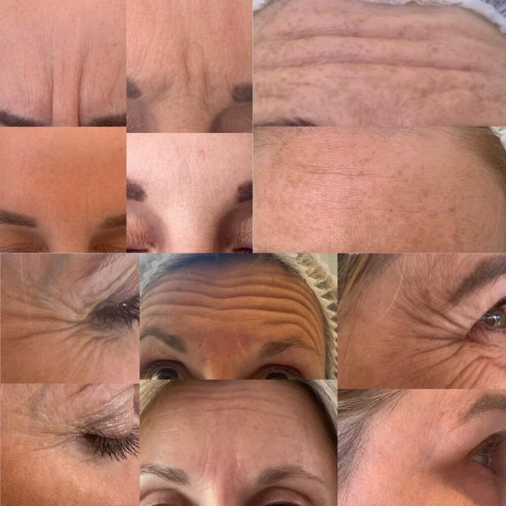 Anti Wrinkle Injections by Mel at the Nail and Beauty Barn, Borley, Hampshire